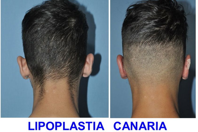 Otoplastia antes y después - 625761
