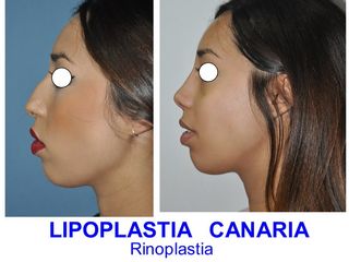 Antes y después Rinoplastia + Septoplastia