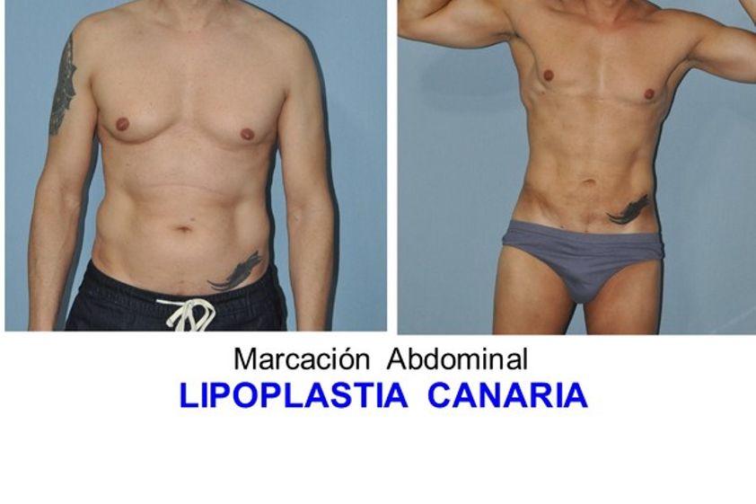 Marcación abdominal antes y después - 627743