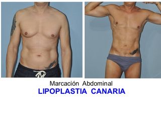 Antes y después marcación abdominal