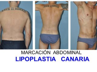 Antes y después marcación abdominal  Lipoescultura HD Vaser - Laser