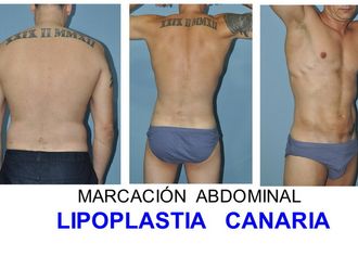 Marcación abdominal - 627744