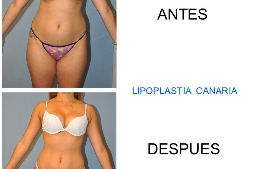 Liposucción antes y después - 847759
