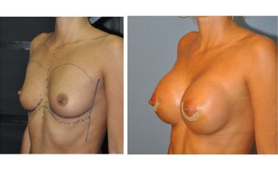 Aumento de pecho - Lipoplastia Canaria (Dr. Ojeda Molina)