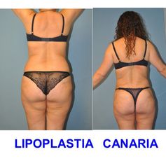 Lipoplastia Canaria (Dr. Ojeda Molina)