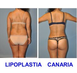 Lipoplastia Canaria (Dr. Ojeda Molina)