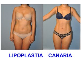 Liposucción antes y después - 847766