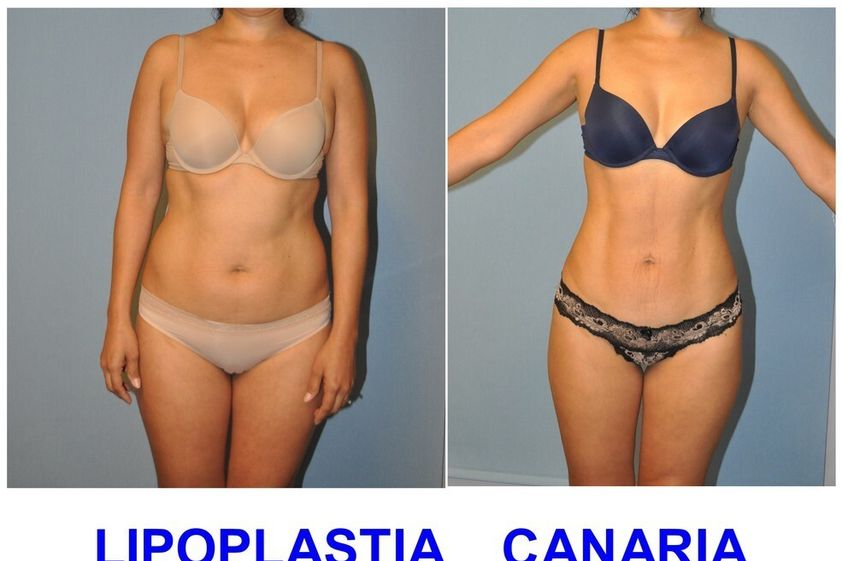 Liposucción antes y después - 847766