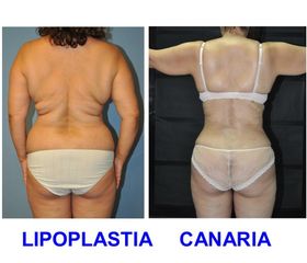 Lipoplastia Canaria (Dr. Ojeda Molina)