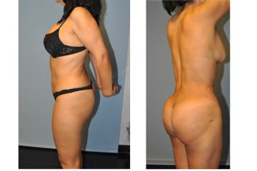 Lipoplastia Canaria (Dr. Ojeda Molina)
