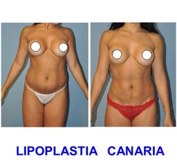 Lipoplastia Canaria (Dr. Ojeda Molina)