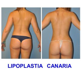 Lipoplastia Canaria (Dr. Ojeda Molina)