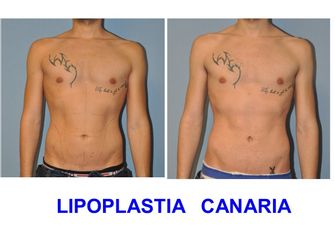 Lipoplastia Canaria (Dr. Ojeda Molina)