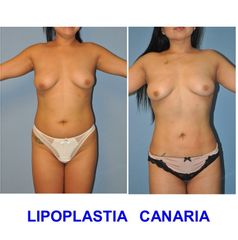 Lipoplastia Canaria (Dr. Ojeda Molina)