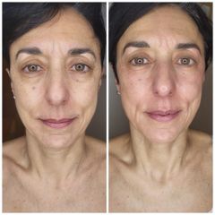 Rejuvenecimiento facial - Clínica Los Arroyos