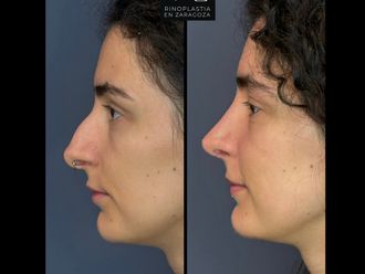 Rinoplastia antes y después - 880123