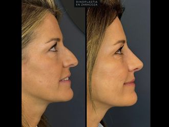 Rinoplastia antes y después - 880124