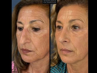 Rinoplastia antes y después - 880125