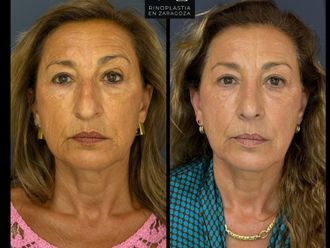 Rinoplastia antes y después - 880126