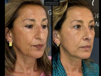 Rinoplastia antes y después - 880127