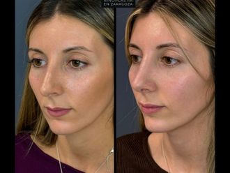 Rinoplastia antes y después - 880128