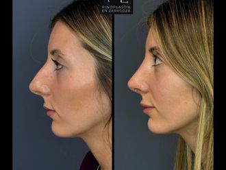 Rinoplastia antes y después - 880129