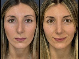 Rinoplastia antes y después - 880130