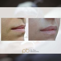 Aumento de labios - Dr. Pau Bosacoma