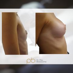 Aumento de pecho - Dr. Pau Bosacoma