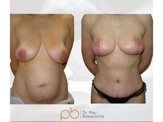 Mastopexia + Liposucción