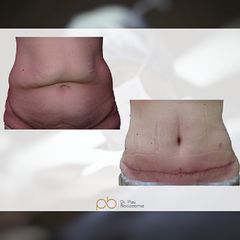 Abdominoplastia - Dr. Pau Bosacoma