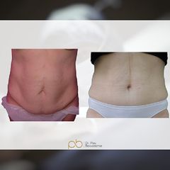 Abdominoplastia - Dr. Pau Bosacoma