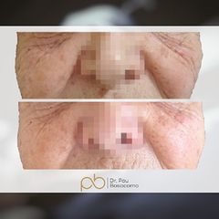 Mesoterapia - Dr. Pau Bosacoma