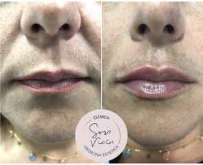 Aumento de labios - Dra. Verónica Sosa Viaín