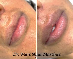 Aumento de labios - Dr. Marc Agea Martínez