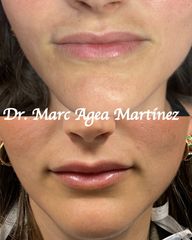 Aumento de labios - Dr. Marc Agea Martínez