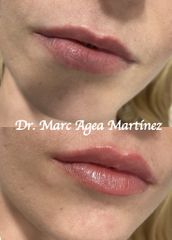 Aumento de labios - Dr. Marc Agea Martínez