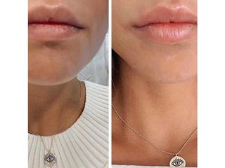 Antes y después aumento de labios - acido hialuronico