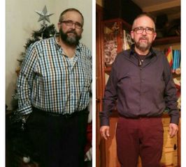 Antes y después Cirugía bariátrica