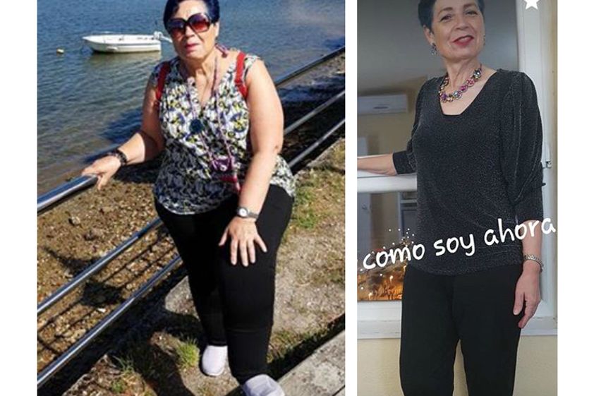 Banda gástrica antes y después - 649262