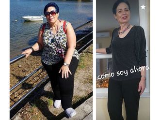 Banda gástrica - 649262