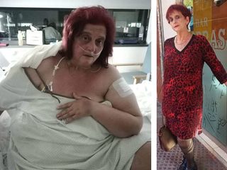 Antes y después (10 meses) - reducción de estomago