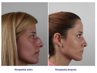 Antes y después de rinoplastia