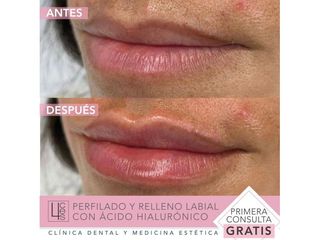 Aumento de labios - Clínica 4Ces