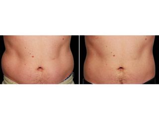 Antes y después Hidrolipoclasia