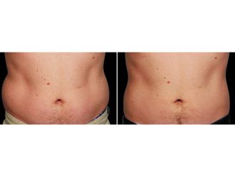 Hidrolipoclasia - 629525