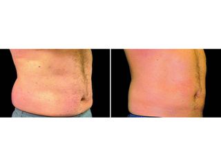 Antes y después Criolipólisis