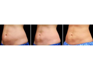 Antes y después Criolipólisis