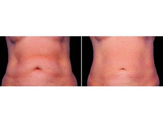 Antes y después Criolipólisis