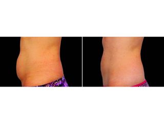 Antes y después Abdominoplastia